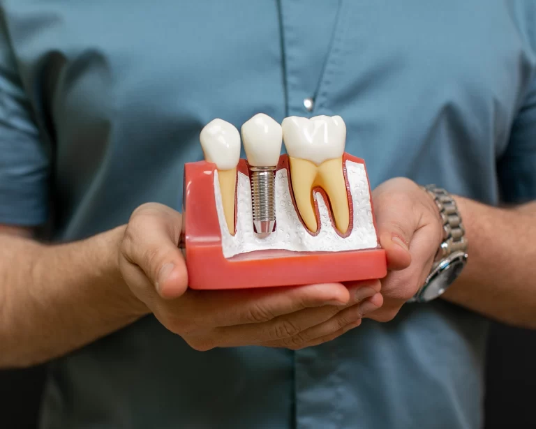 teeth-implant